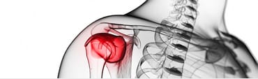 Bursitis