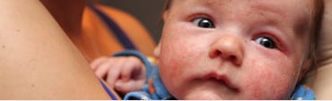 Eczema