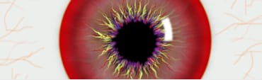 Glaucoma